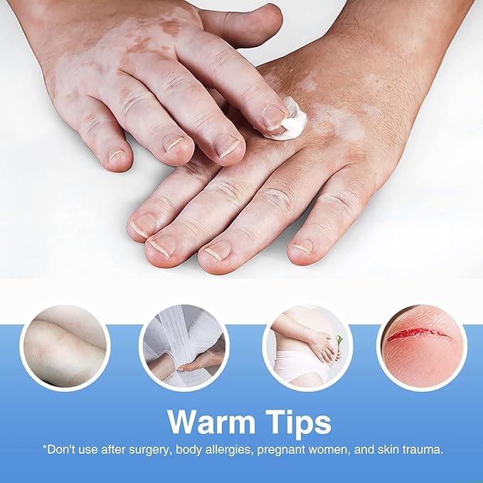 Vitiligo Cream, Natural Vitiligo Treatment Cream for Skin Vitiligo, Suitable for Skin Vitiligo, Leukoplakia, Suitable for Men and Women