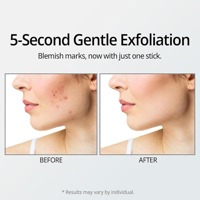 DR.ORACLE 21 Stay A-Thera Peeling Stick for Sensitive Skin - AHA, BHA, Tea Tree Oil, Exfoliating Swabs for Blackheads, Whiteheads, Enlarged Pores, Korean Skincare, Dermatologist Tested, 1Pack of 10ea