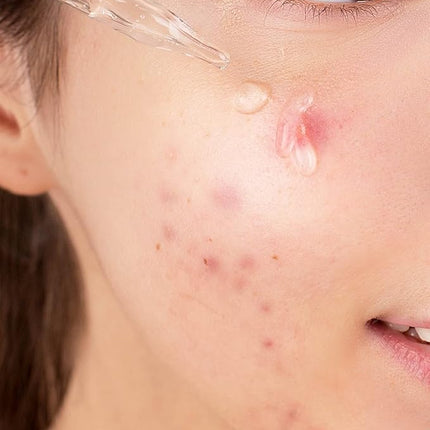 Korean Skin Care Serum Vitamin B, C Serum for Face - Niacinamide 10% Zinc 1% - K Beauty Hydrating Facial Serum - 1fl.oz.(30ml)