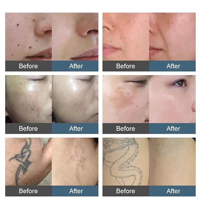 2 IN 1 Fast Effective Hair Removal Machine with Ice Handle, Professional Salon Beauty Device Melainin Pigment Speckle Removal Skin Whitening Tools