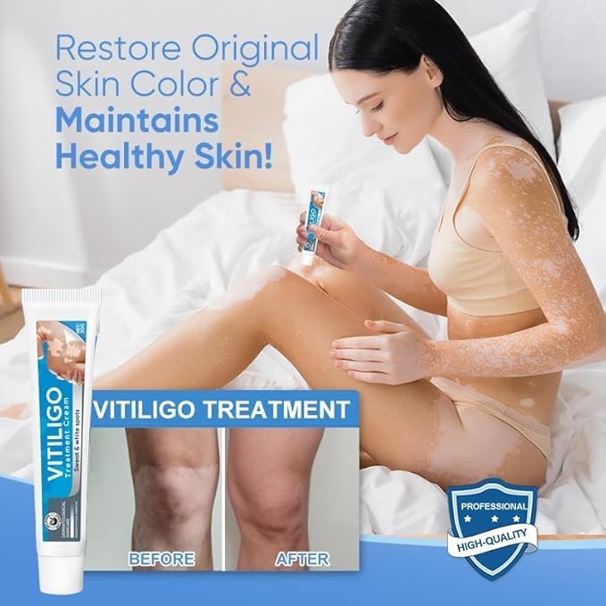 Vitiligo Cream, Natural Vitiligo Treatment Cream for Skin Vitiligo, Suitable for Skin Vitiligo, Leukoplakia, Suitable for Men and Women