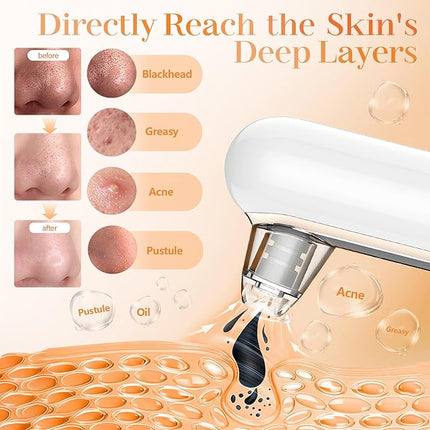 Yccu Blackhead Remover Vacuum Blackhead Vacuum Remover Pore Extractor Blackhead Remover Tool Black Head Remover for Face Blackhead Extractor Pore Cleaner Vacuum with USB Charge 4 Modes 5 Suction Heads