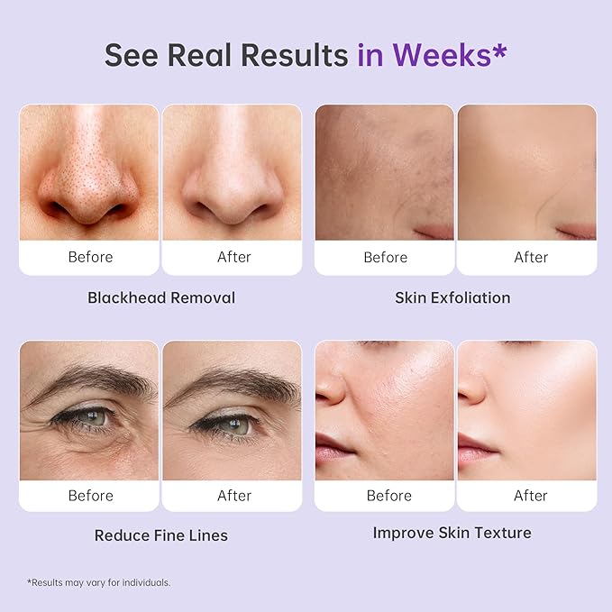 Blackhead Vacuum Removers, 2 in 1 Pro-Grade at-Home Spa Facial Vacuum Pore Cleaner for Blackheads, Whiteheads, Exfoliation, 20-80 Kpa Adjustable Suction for All Skin Types, White