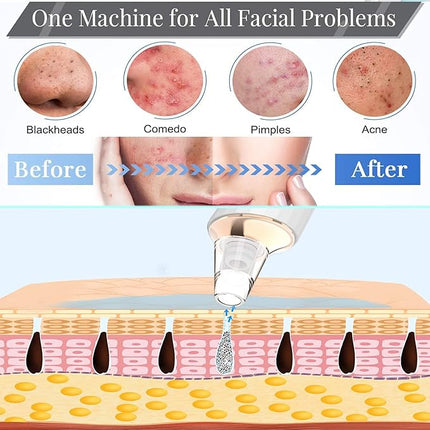 Blackhead Remover Pore Vacuum, Upgraded USB Rechargeable Facial Pore Cleaner Blackhead Removal Kit with 3 Suction Power,5 Probes Black Head Extractions Tool for Women & Men