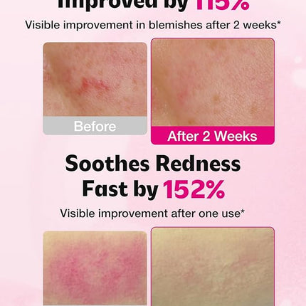 ISOI Blemish Care Up Serum for Face, Vegan Hydrating Serum for Smooth & Glass Skin Effect, Skin Barrier & Moisture Balance for Women, Arbutin & Rose Otto Oil, Korean Skin Care (1.18 fl. oz, 35ml)