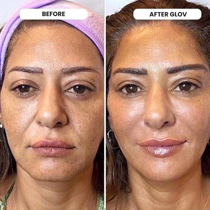 Micro Infusion System - 0.25mm 24k Gold Cosmetic Facial Stamp with Hyaluronic Acid & Peptide Serum Ampoules - At-Home Hydrating & Plumping Glow Kit for Face & Lips