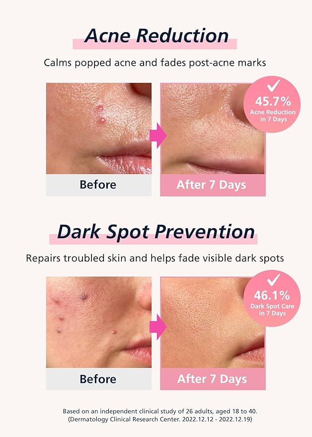 Easyderm Real Calming Patch Micropoint Pimple Patches, Niacinamide, Hyaluronic Acid, EGF, K-Beauty Skincare | 6 Patches per Pack, 4 Packs (24 Total) Micro Piont length : 285μm