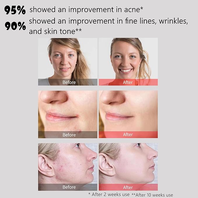 Led Face Mask Light Therapy, Halo Led Light Therapy Facial and Neck Skin Care Mask, Blue Light Red Light for Acne Wrinkle Reduce, New Generation Face and Neck Photon Mask