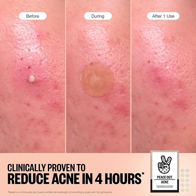 PEACE OUT Acne Healing Dots Helps Clear Blemishes Overnight, Fast Acting Hydrocolloid Pimple Patches for Breakouts with Salicylic Acid, Retinol and Aloe Vera, Award Winning Skincare Solution 10 Count