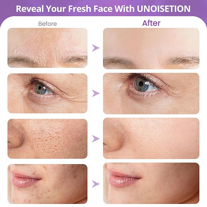 Diamond Microdermabrasion Machine, UNOISETION 3 in 1 Dermabrasion Facial Machine for Exfoliation & Blackhead Removal, Home Use Facial Skin Care Device