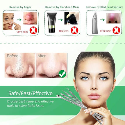 5PCS Blackhead Remover Comedone Extractor, Curved Blackhead Tweezers Kit, Professional Stainless Pimple Acne Blemish Removal Tools Kit for Manual