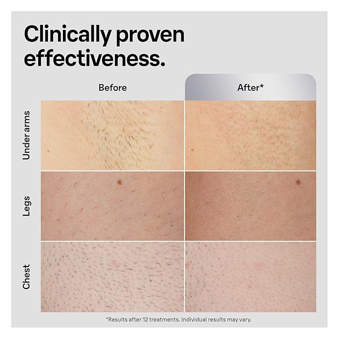 Braun Smart IPL, Silk·Expert Pro 5: at Home Laser Hair Removal Device for Men & Women, Permanent Visible Hair Reduction in Hair Regrowth for Body, w/Razor, Pouch, and Wide Cap Head, IPL5145