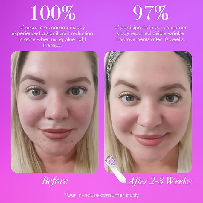 reVive Light Therapy Lux Collection Clinical Acne and Anti-Aging Device